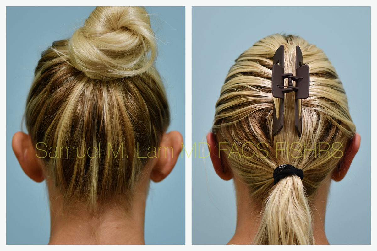 Otoplasty Before and After Photo by Dr. Lam in Plano, TX
