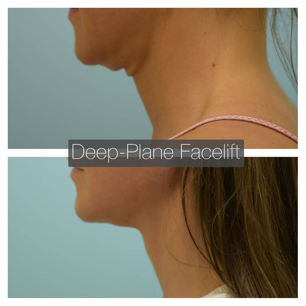 Deep Plane Facelift Before and After Photo by Dr. Lam in Plano, TX