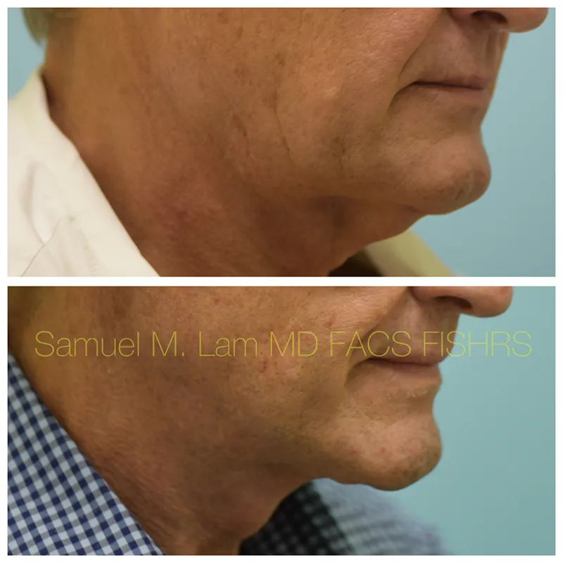 Facelift Before and After Photo by Dr. Lam in Plano TX