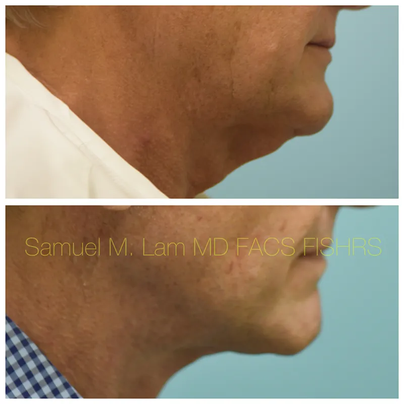 Facelift Before and After Photo by Dr. Lam in Plano TX