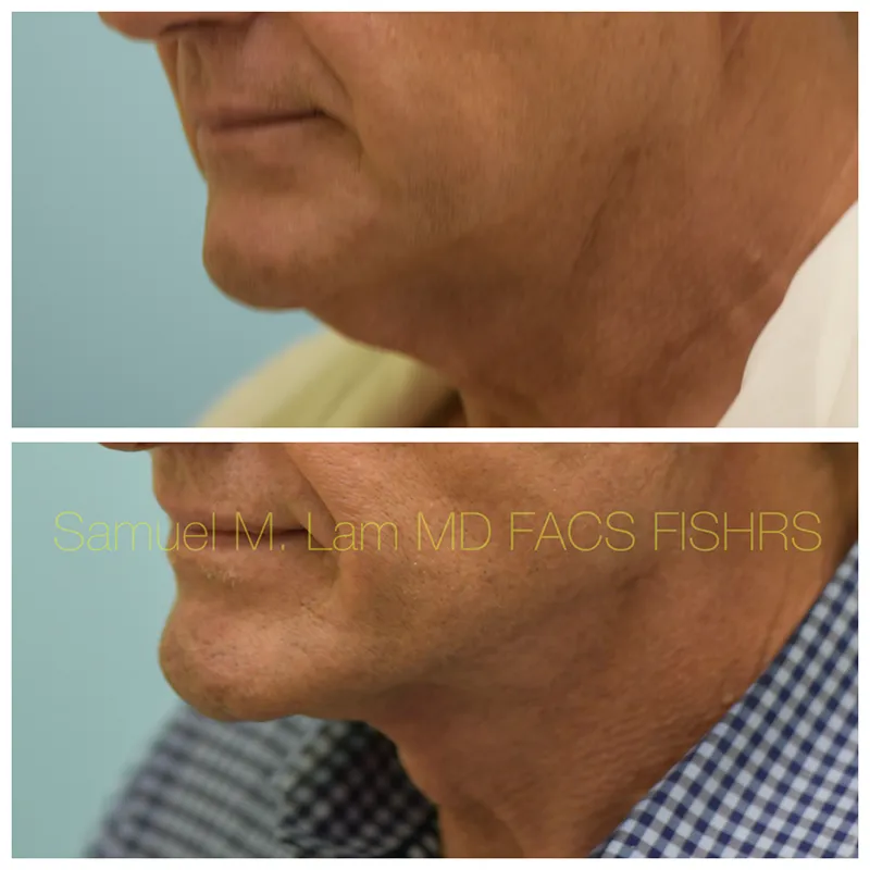 Facelift Before and After Photo by Dr. Lam in Plano TX
