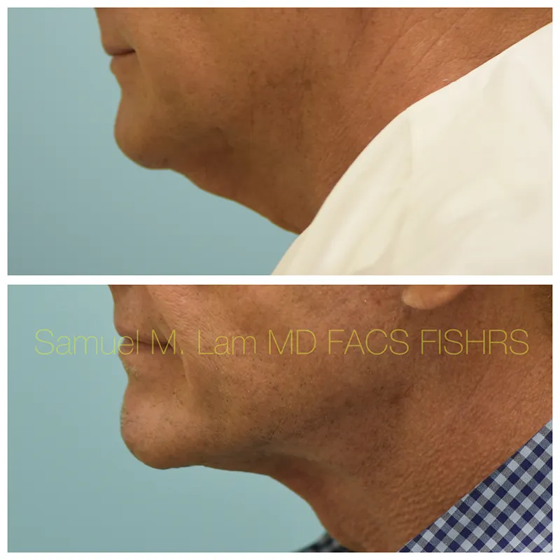 Facelift Before and After Photo by Dr. Lam in Plano TX