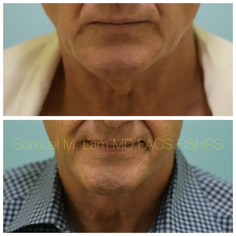 Facelift Before and After Photo by Dr. Lam in Plano TX