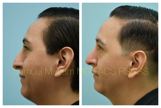 Rhinoplasty Before and After Photo by Dr. Lam in Plano TX