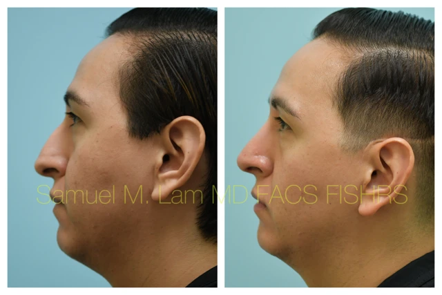 Rhinoplasty Before and After Photo by Dr. Lam in Plano TX