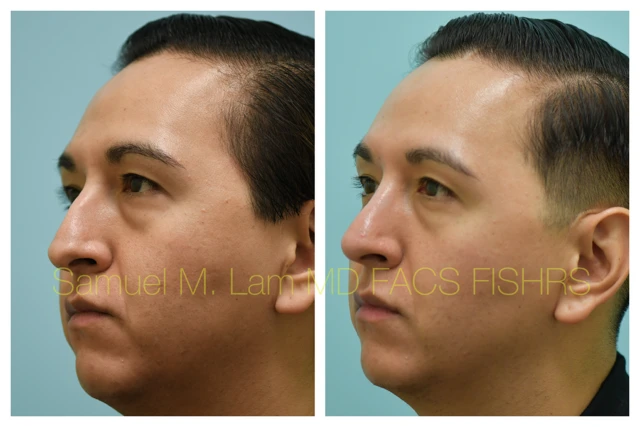 Rhinoplasty Before and After Photo by Dr. Lam in Plano TX