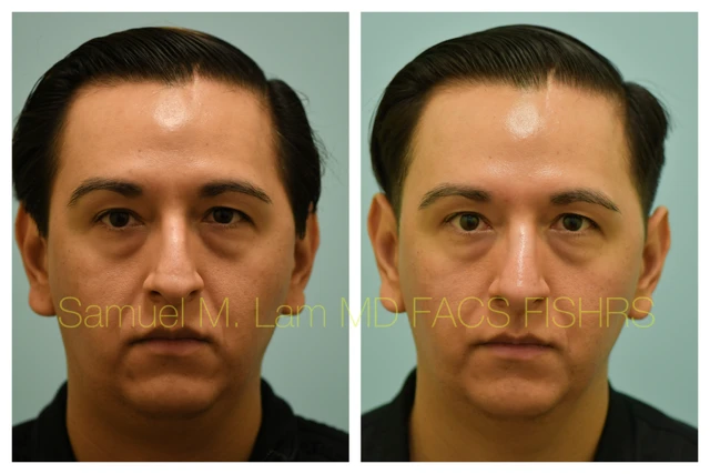 Rhinoplasty Before and After Photo by Dr. Lam in Plano TX