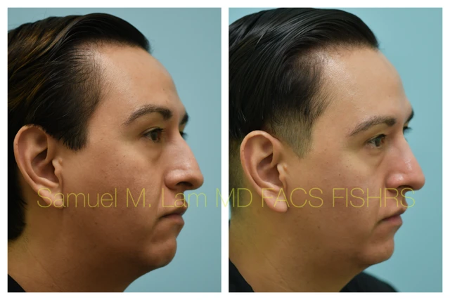 Rhinoplasty Before and After Photo by Dr. Lam in Plano TX