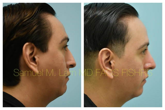 Rhinoplasty Before and After Photo by Dr. Lam in Plano TX
