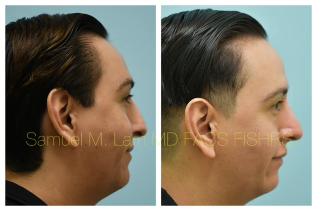 Rhinoplasty Before and After Photo by Dr. Lam in Plano TX