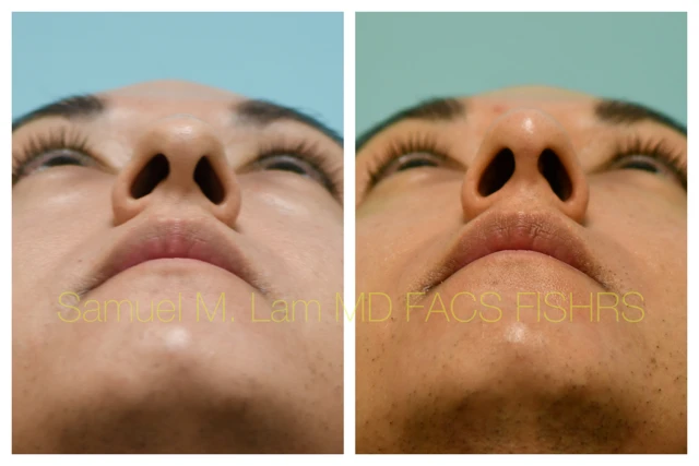 Rhinoplasty Before and After Photo by Dr. Lam in Plano TX