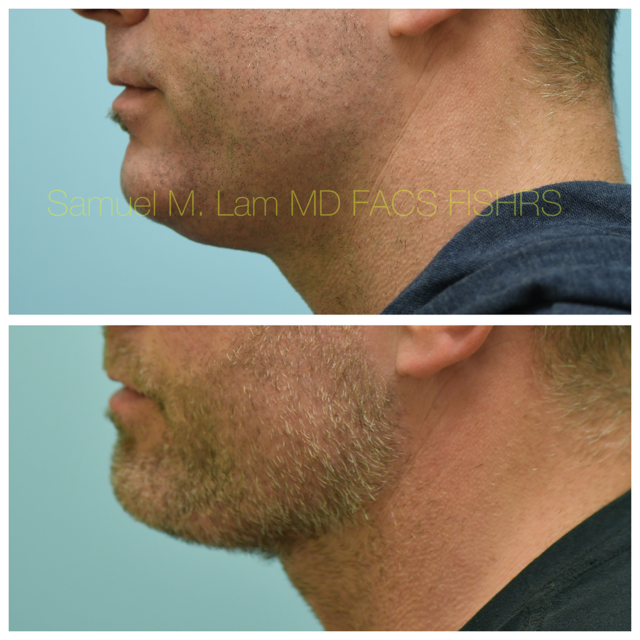 Facelift Before and After Photo by Dr. Lam in Plano, TX