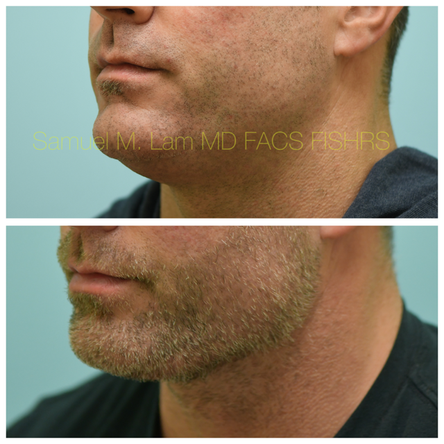 Facelift Before and After Photo by Dr. Lam in Plano, TX