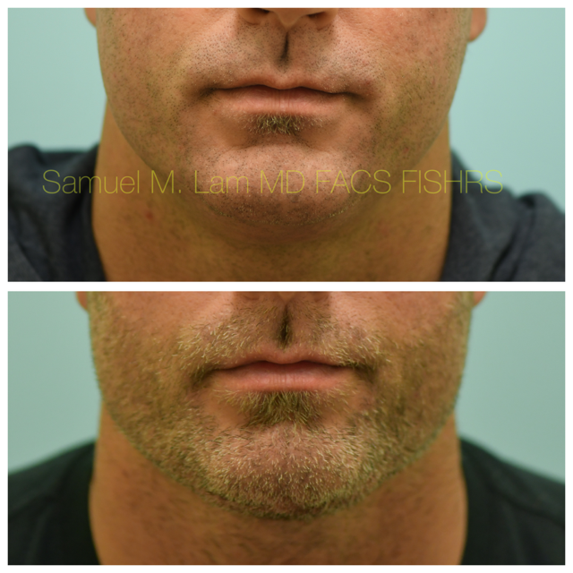 Facelift Before and After Photo by Dr. Lam in Plano, TX