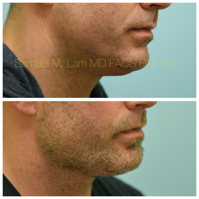 Facelift Before and After Photo by Dr. Lam in Plano, TX