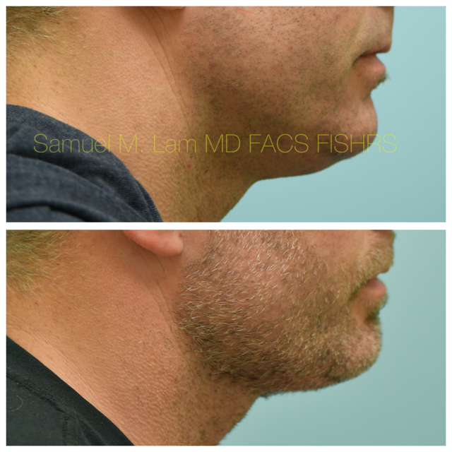 Facelift Before and After Photo by Dr. Lam in Plano, TX