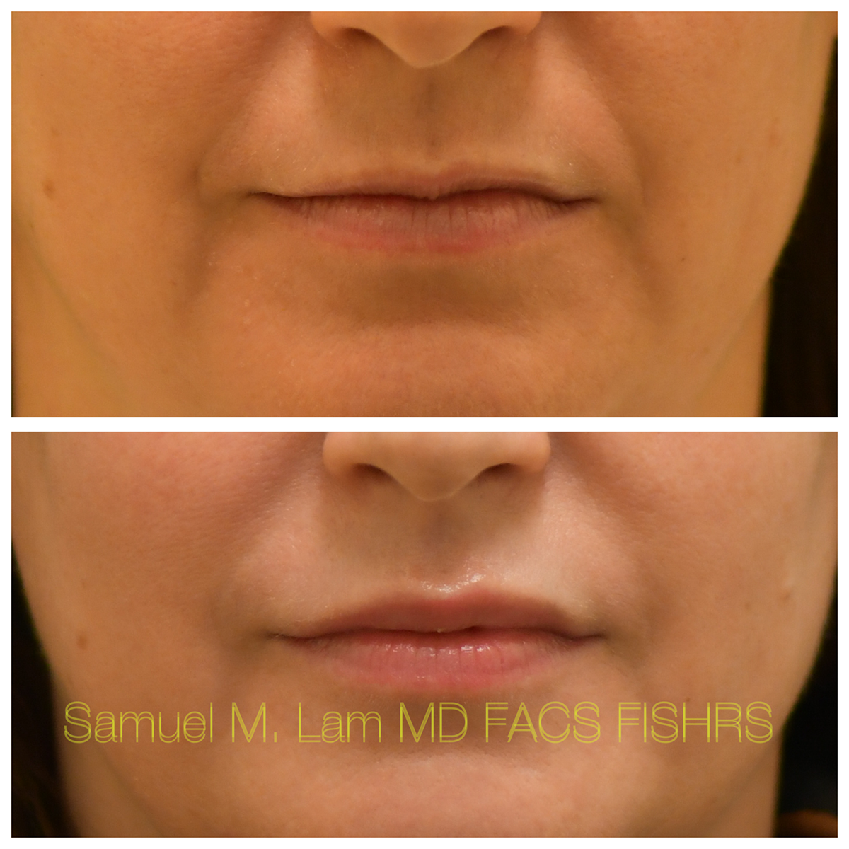 Lip Filler Before and After Photo by Dr. Lam in Plano, TX