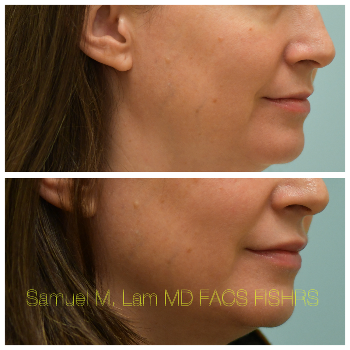 Lip Filler Before and After Photo by Dr. Lam in Plano, TX
