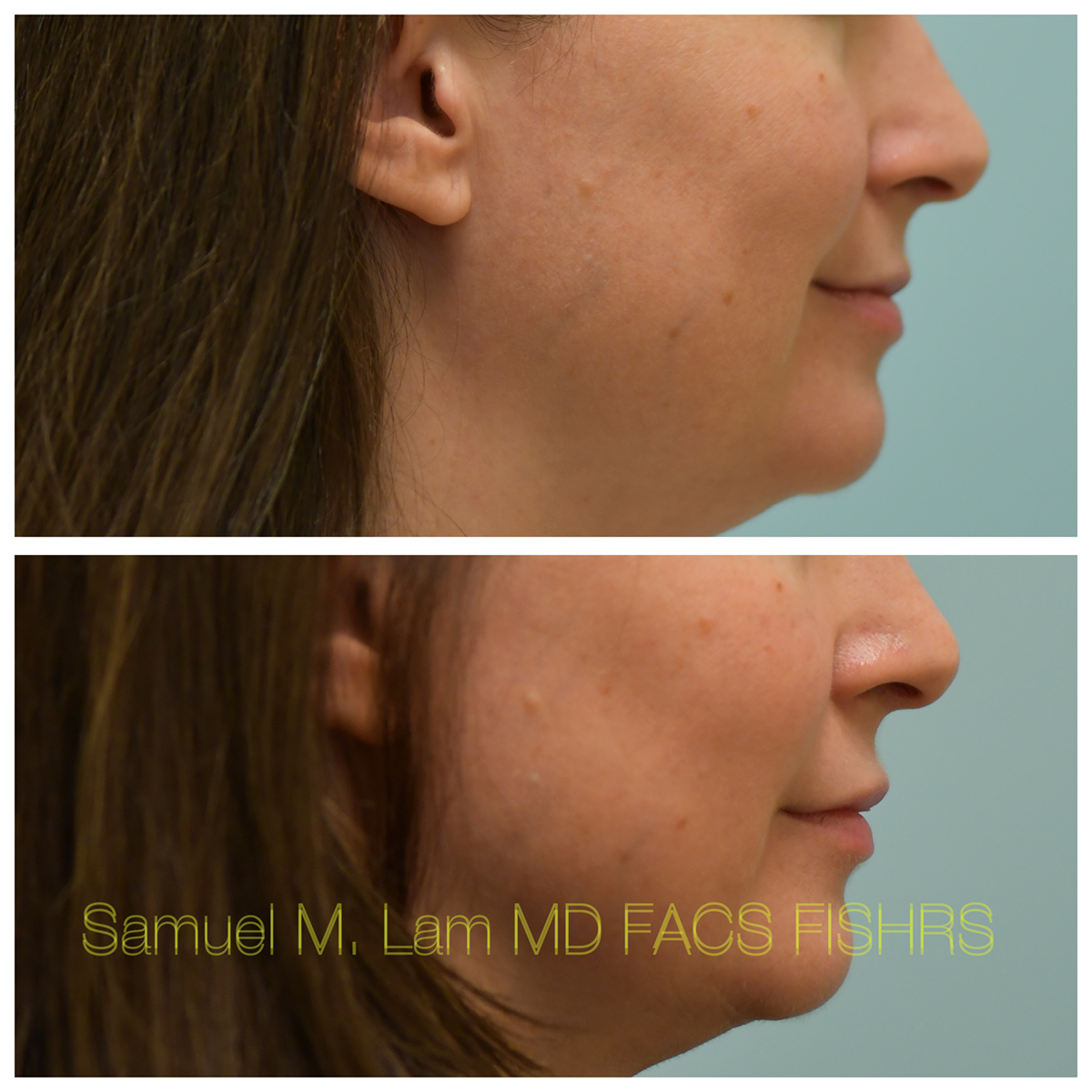 Lip Filler Before and After Photo by Dr. Lam in Plano, TX