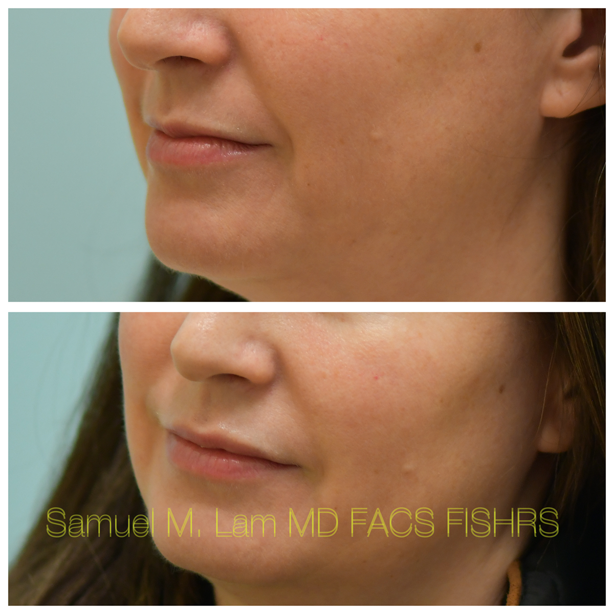 Lip Filler Before and After Photo by Dr. Lam in Plano, TX