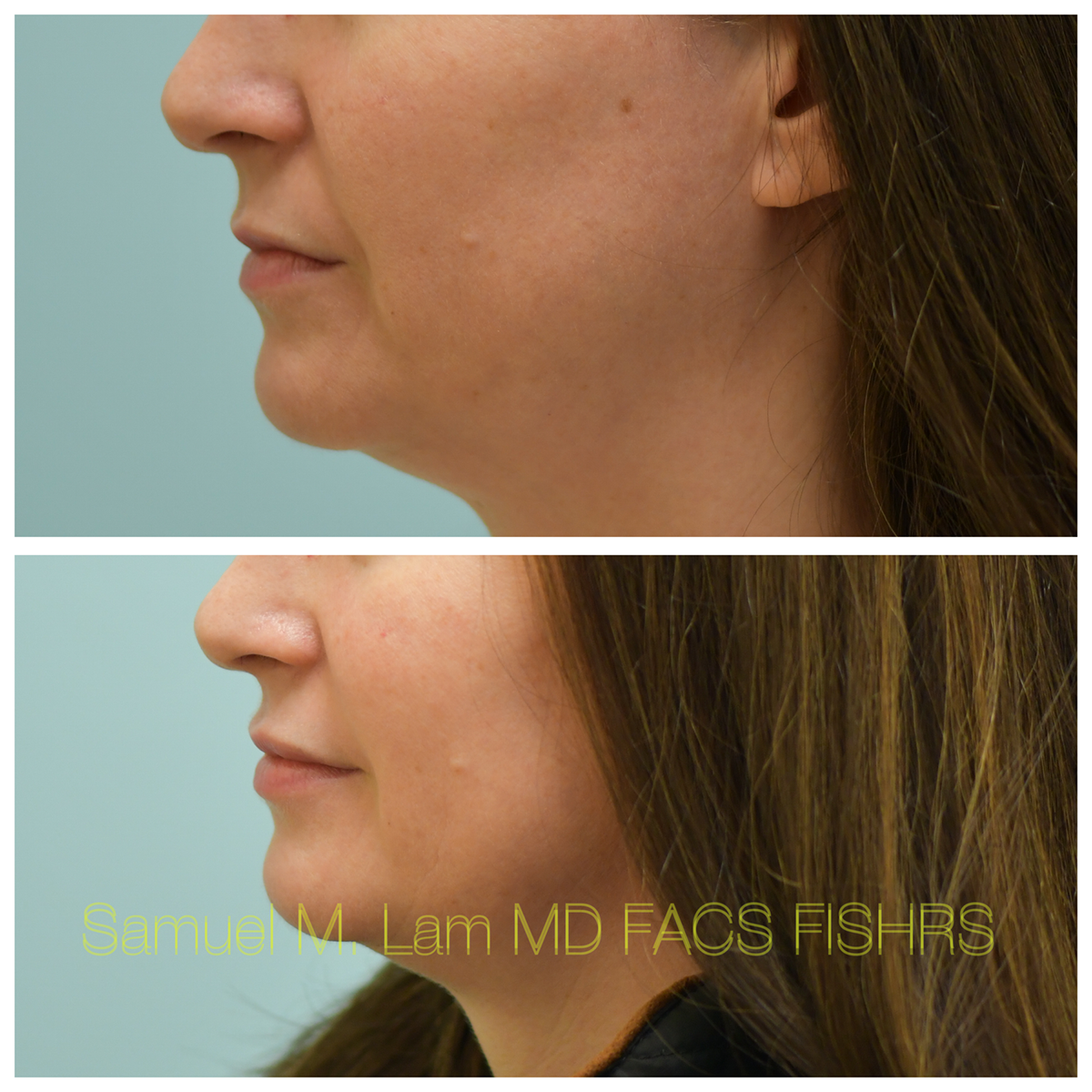 Lip Filler Before and After Photo by Dr. Lam in Plano, TX