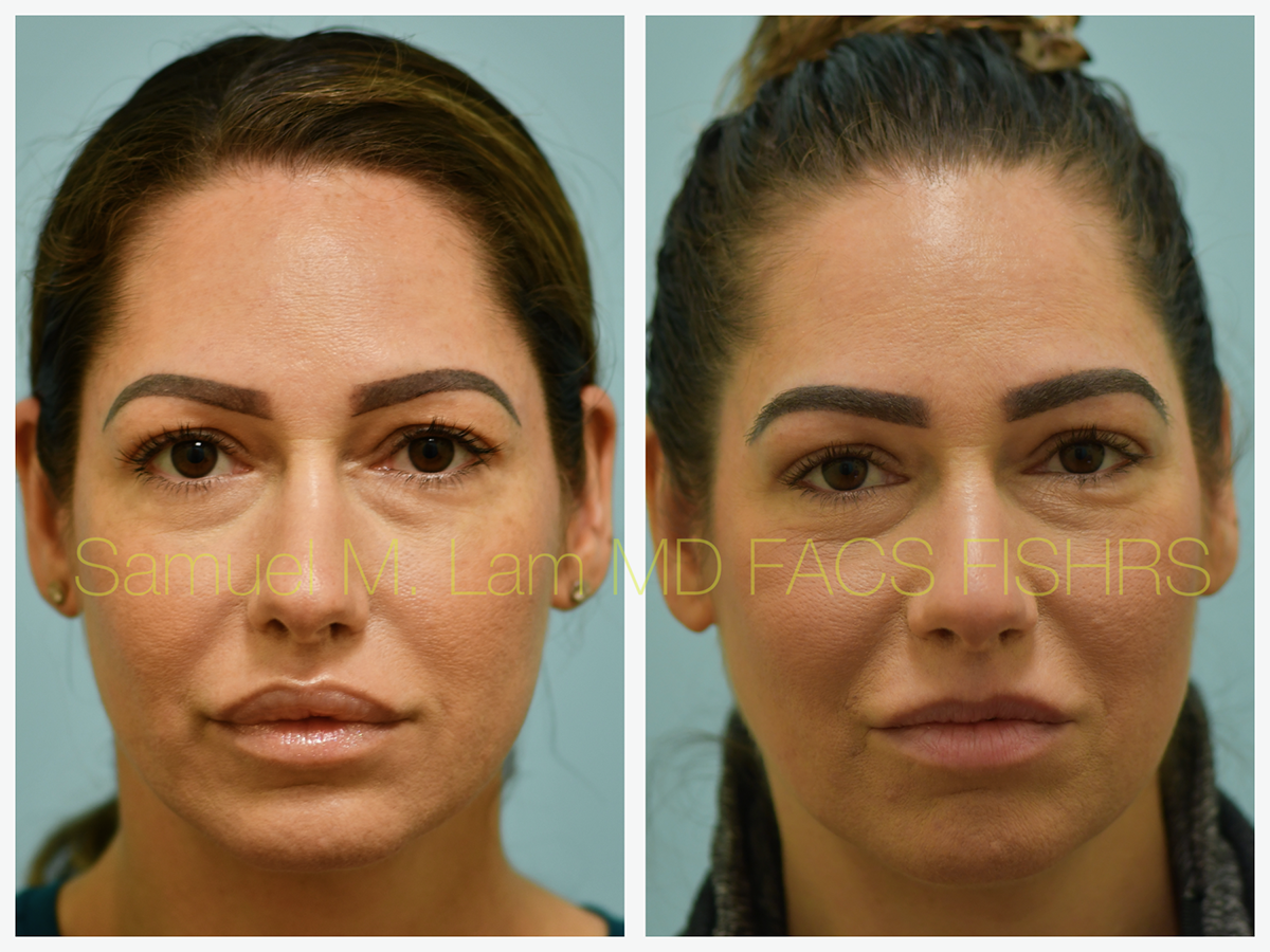 Lip Reduction Before and After Photo by Dr. Lam in Plano, TX