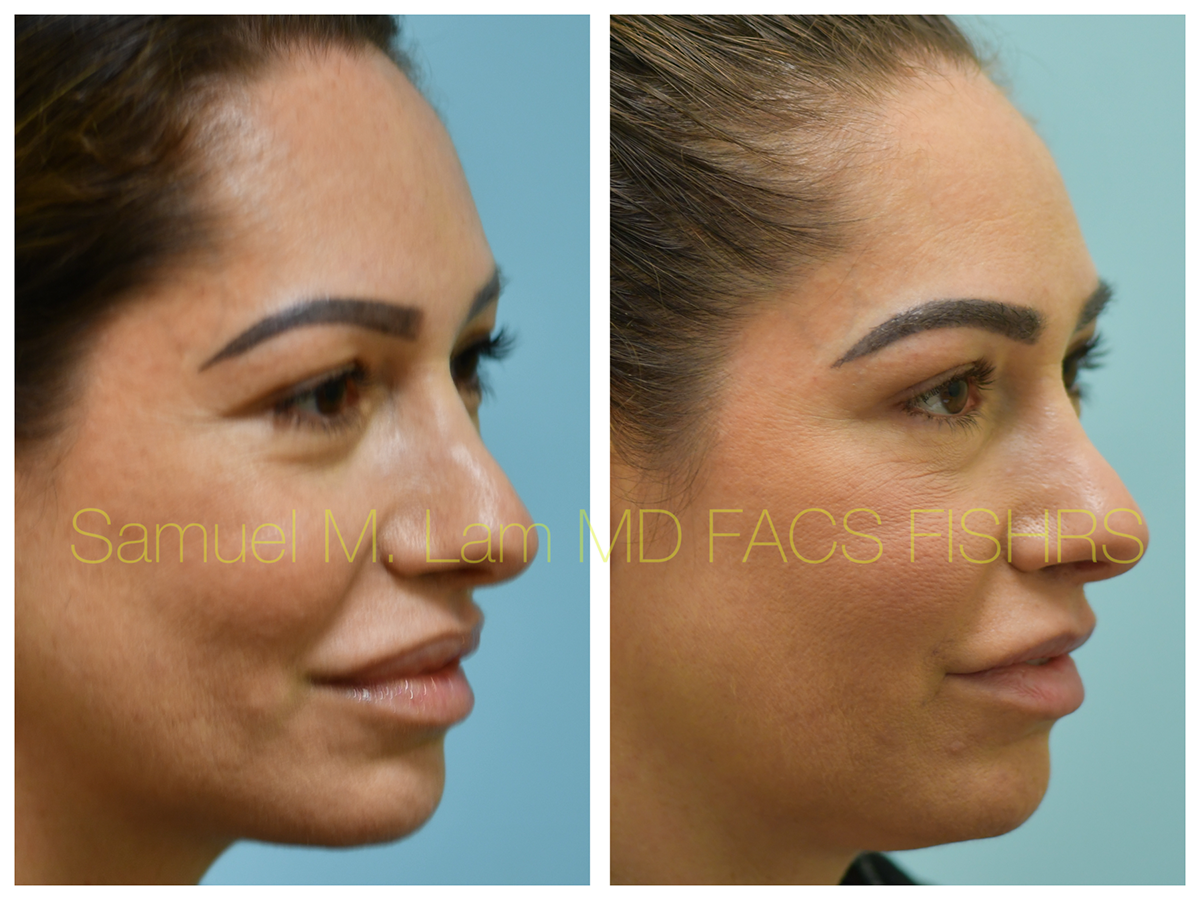 Lip Reduction Before and After Photo by Dr. Lam in Plano, TX