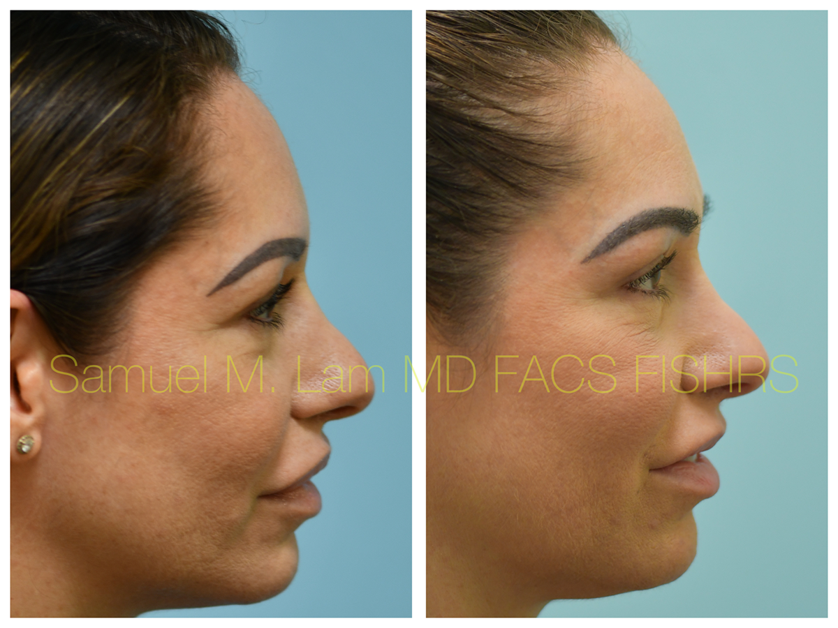 Lip Reduction Before and After Photo by Dr. Lam in Plano, TX