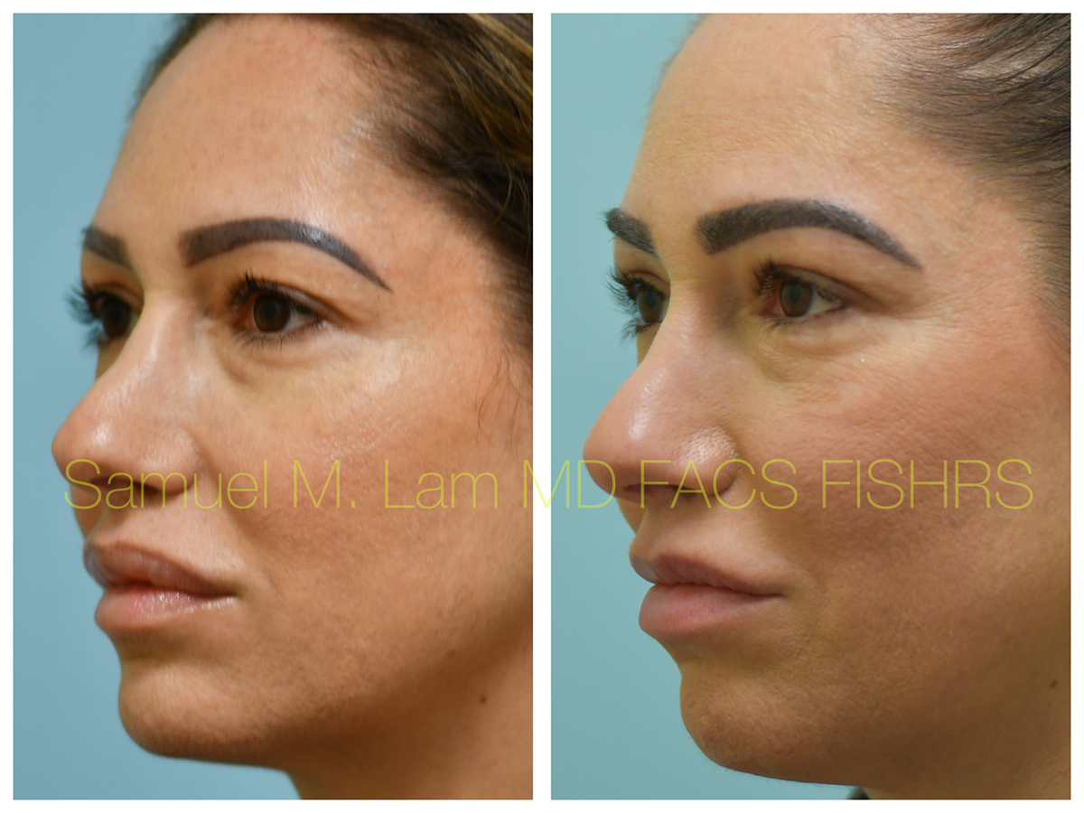 Lip Reduction Before and After Photo by Dr. Lam in Plano, TX