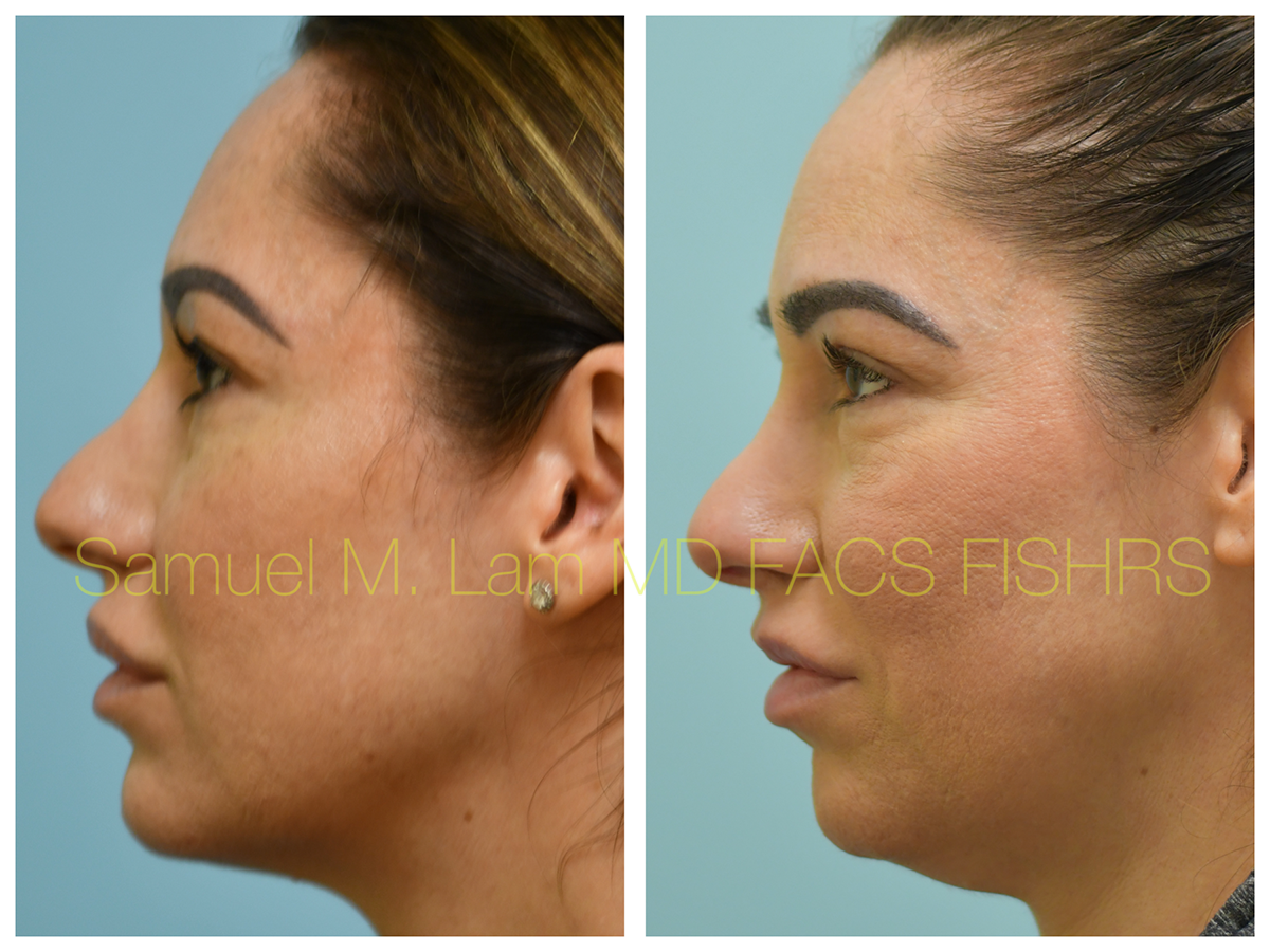 Lip Reduction Before and After Photo by Dr. Lam in Plano, TX