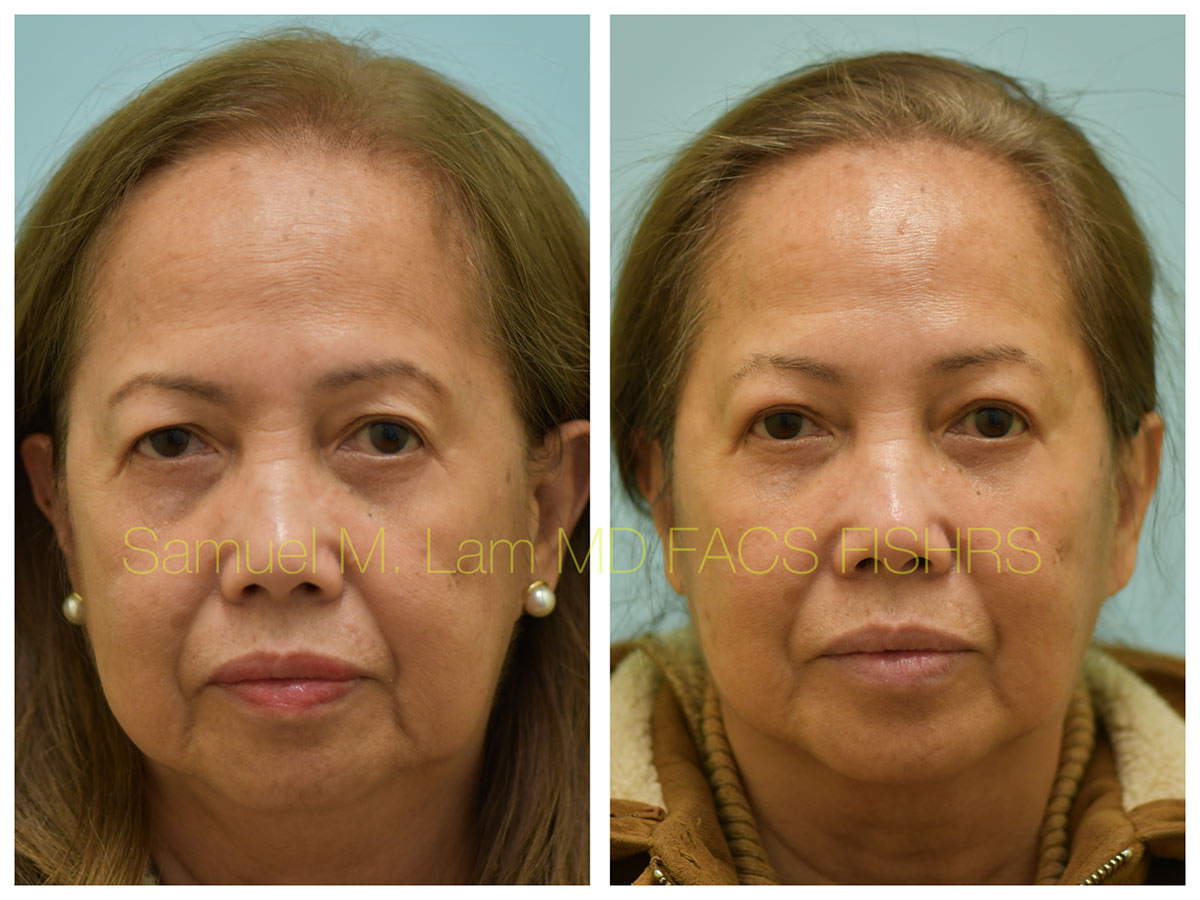 Blepharoplasty and Fat Grafting Before and After Photo by Dr. Lam in Plano, TX