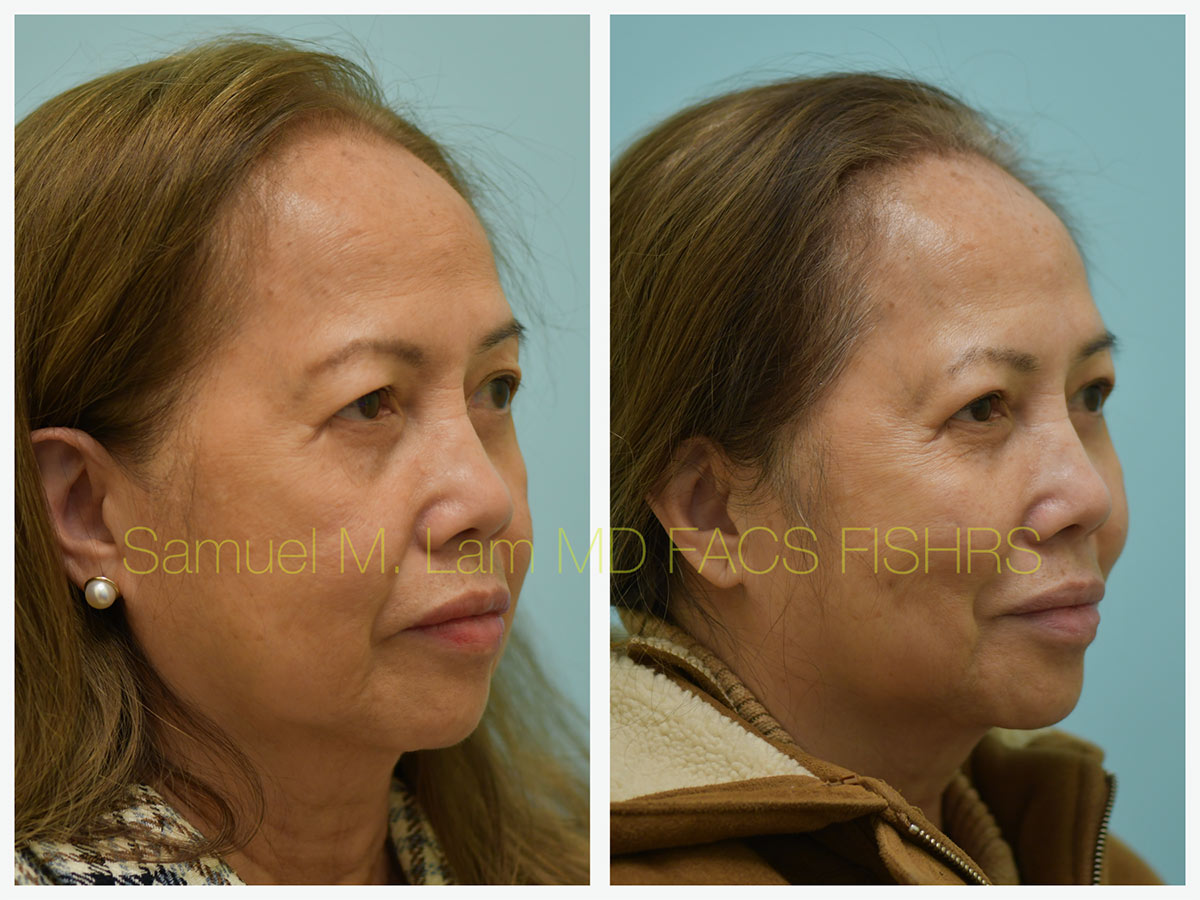 Blepharoplasty and Fat Grafting Before and After Photo by Dr. Lam in Plano, TX