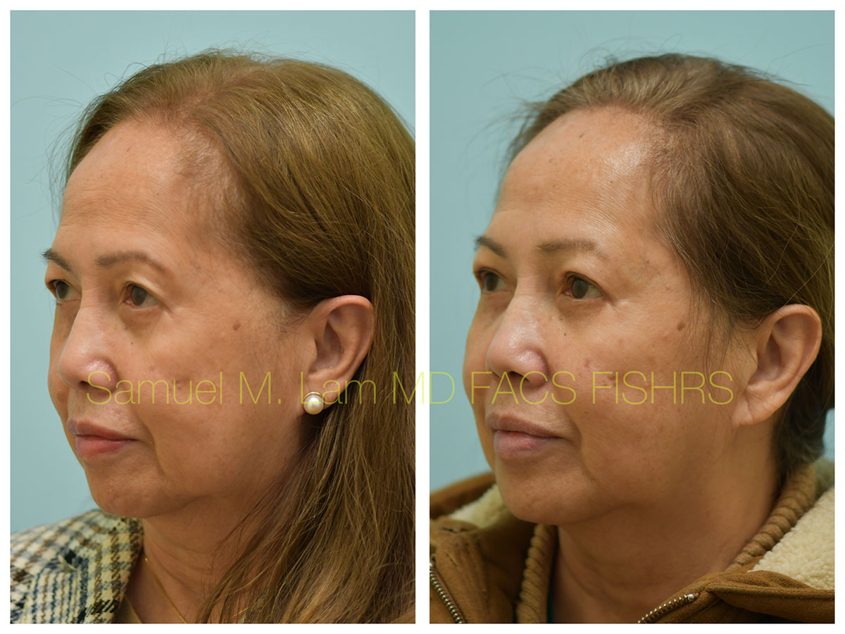 Blepharoplasty and Fat Grafting Before and After Photo by Dr. Lam in Plano, TX