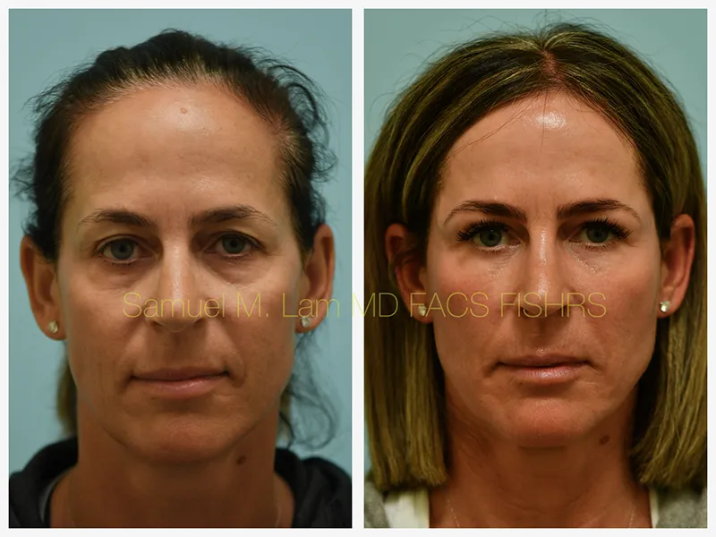 Eyelid Blepharoplasty Before and After Photo by Dr. Lam in Plano TX