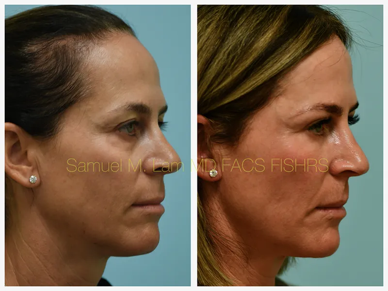 Eyelid Blepharoplasty Before and After Photo by Dr. Lam in Plano TX