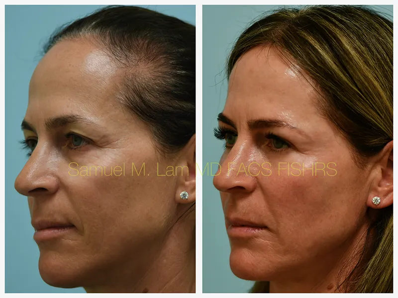 Eyelid Blepharoplasty Before and After Photo by Dr. Lam in Plano TX