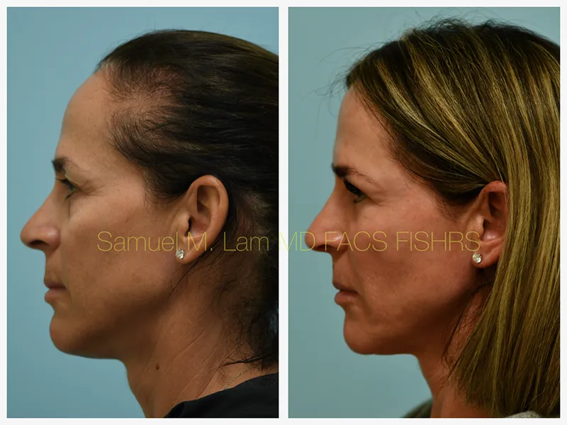 Eyelid Blepharoplasty Before and After Photo by Dr. Lam in Plano TX