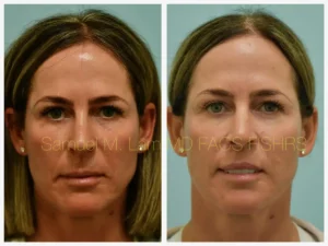 Lip Lift Before and After Photo by Dr. Lam in Plano TX