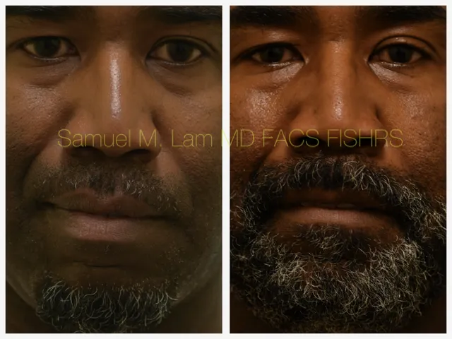 Lip Reduction Before and After Photo by Dr. Lam in Plano TX