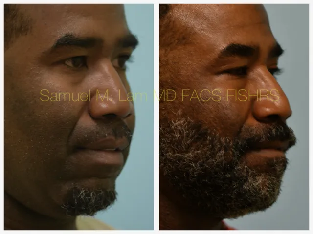 Lip Reduction Before and After Photo by Dr. Lam in Plano TX