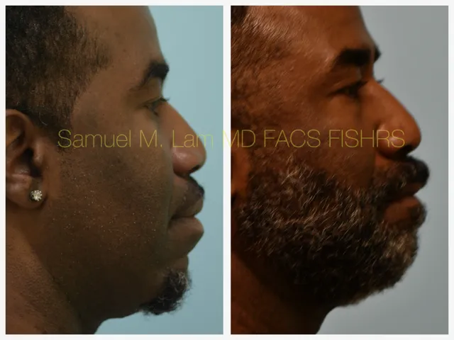 Lip Reduction Before and After Photo by Dr. Lam in Plano TX