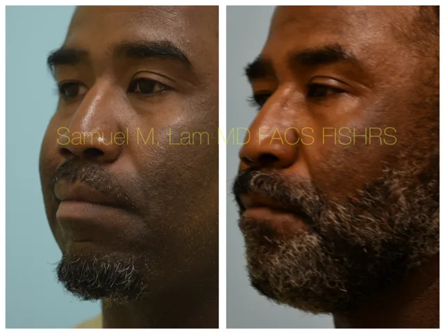 Lip Reduction Before and After Photo by Dr. Lam in Plano TX