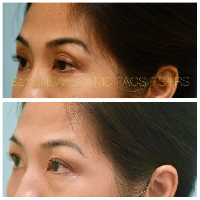 Bilateral ptosis Before and After Photo by Dr. Lam in Plano TX
