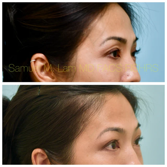Bilateral ptosis Before and After Photo by Dr. Lam in Plano TX