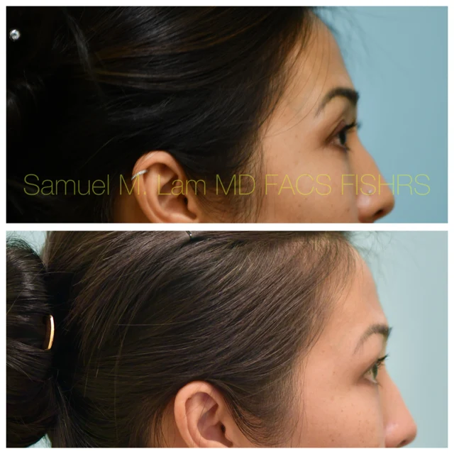 Bilateral ptosis Before and After Photo by Dr. Lam in Plano TX