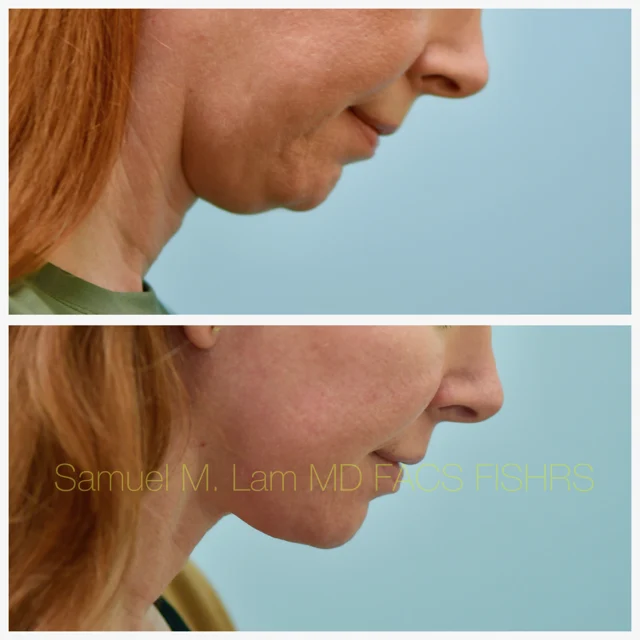 Facelift Before and After Photo by Dr. Lam in Plano TX