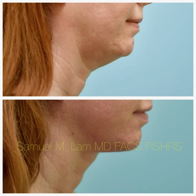 Facelift Before and After Photo by Dr. Lam in Plano TX