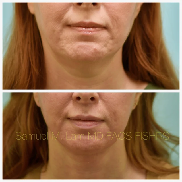 Facelift Before and After Photo by Dr. Lam in Plano TX