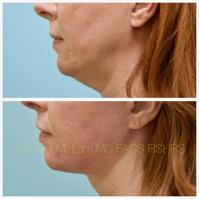 Facelift Before and After Photo by Dr. Lam in Plano TX