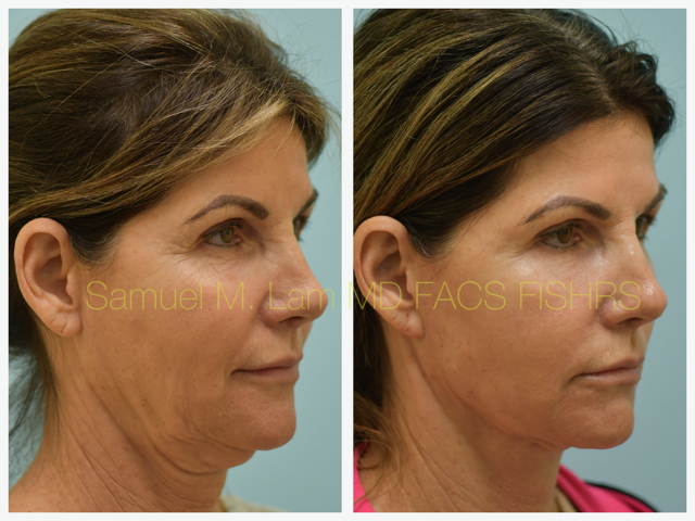 Fat Grafting and Facelift Before and After Photo by Dr. Lam in Plano, TX